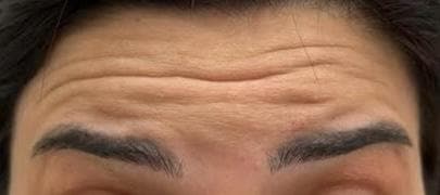 Forehead Smoothing — before treatment