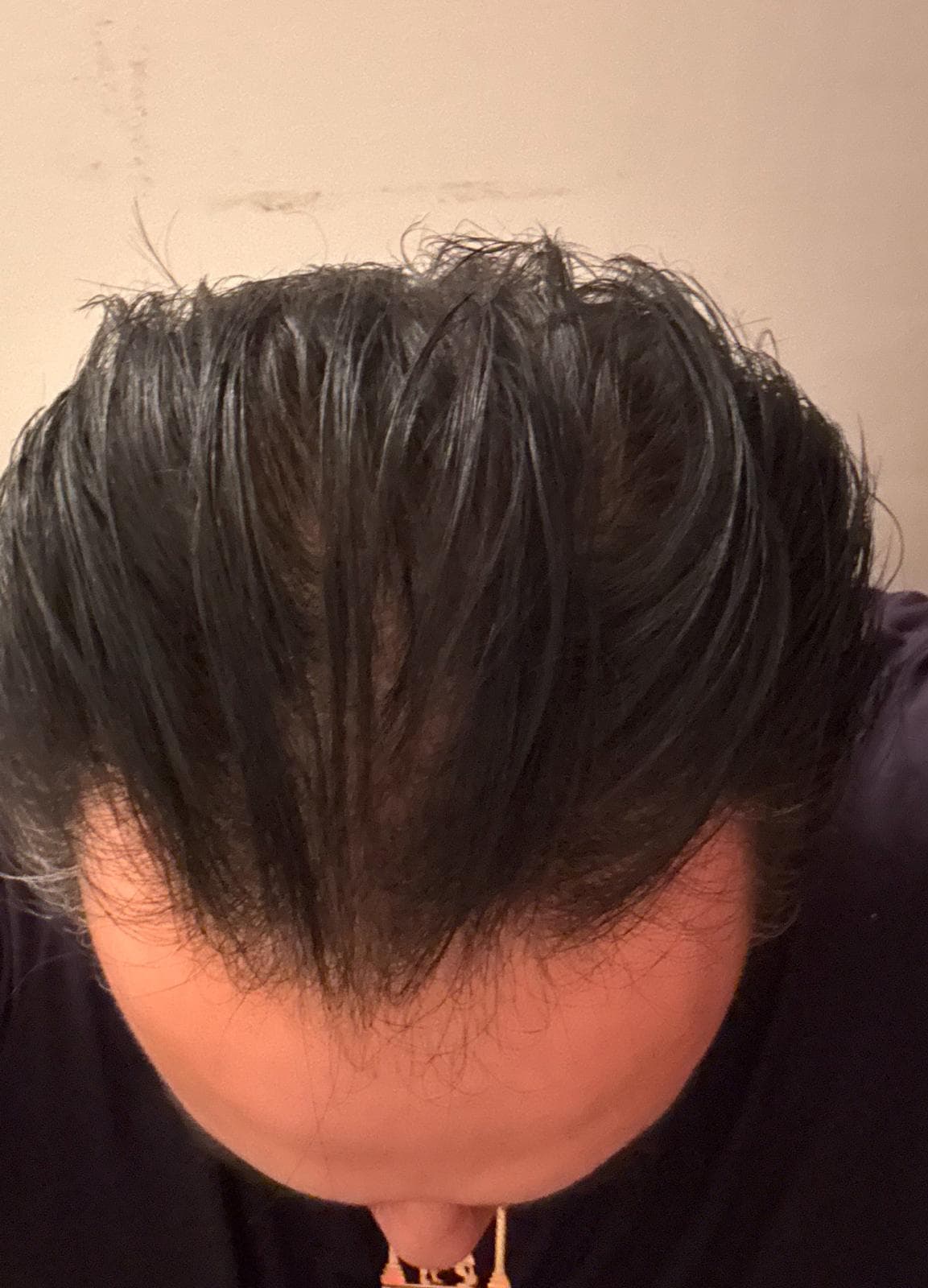 Hair Restoration — after treatment